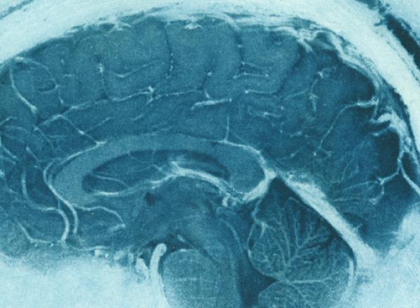 Daniel's Brain, Sagittal MRI view of a neurologist's MRI. Courtesy Elizabeth Jameson